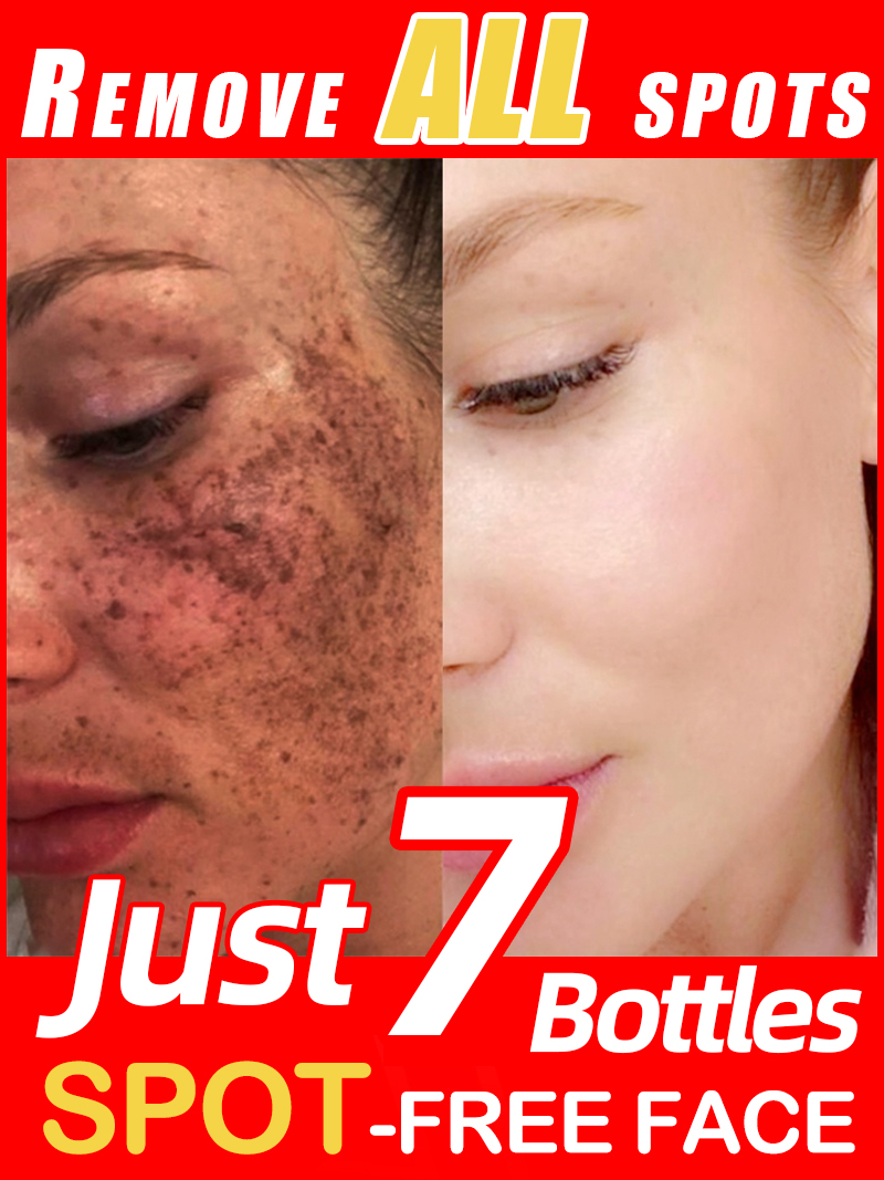 Luxury Natural Skincare - Lighten Freckles Melasma, Facial Dark Spots